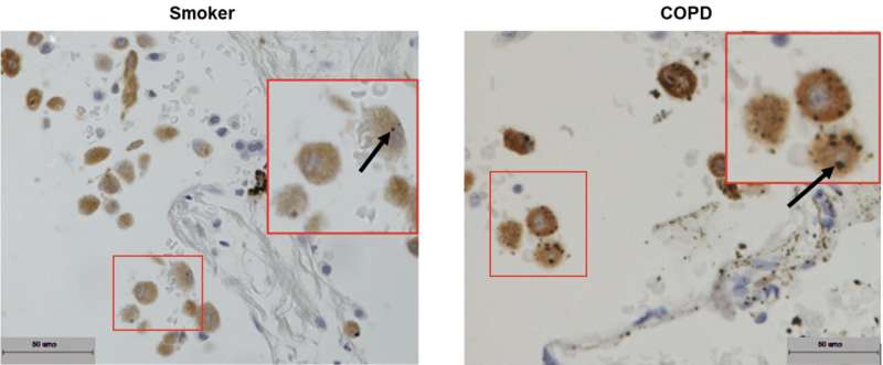 Scientists find unusual build-up of soot-like particles in lung cells of COPD patients